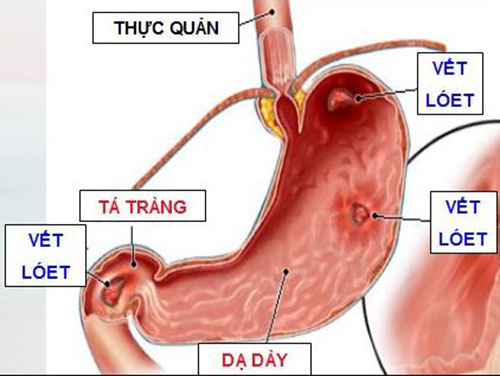 Tìm hiểu về bệnh trào ngược dạ dày thực quản và viêm loét dạ dày